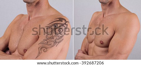 tattoo removal stock images royalty free images u0026 vectors tattoo removal stock images royalty free images u0026 vectors