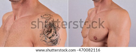 beautiful young woman before after laser stock photo 378965629 beautiful young woman before after laser stock photo 378965629