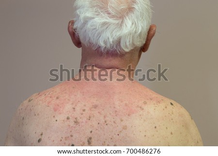 Skin Hives Stock Images, Royalty-Free Images & Vectors | Shutterstock