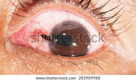Close Up Of The Rupture Globe With Iris Prolapse During Eye Examination Close Up Of The Rupture Globe With Iris Prolapse During Eye Examination