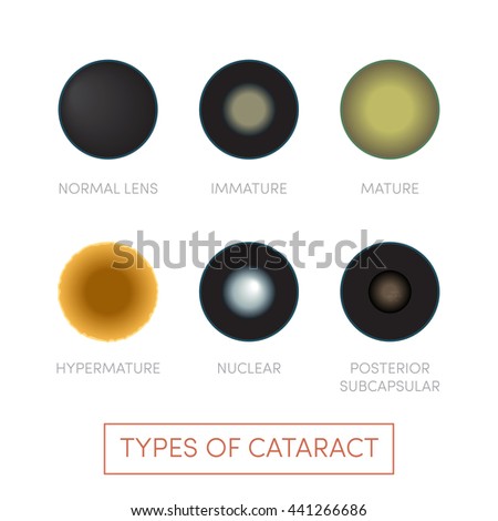 cataract forms When a cataract forms, the natural human lens becomes cloudy, often a yellowish-brown color it not only blocks light from entering the eye, but also scatters. cataract forms When a cataract forms, the natural human lens becomes cloudy, often a yellowish-brown color it not only blocks light from entering the eye, but also scatters.