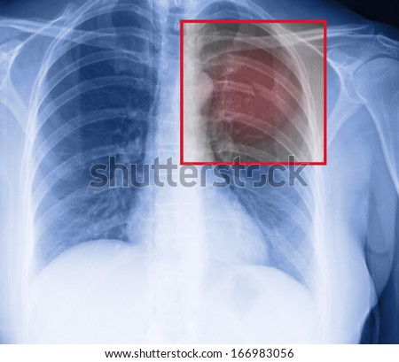 broken ribs - stock photo