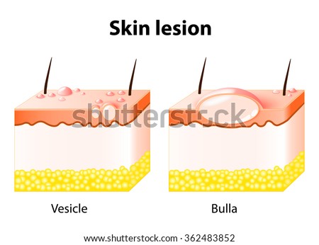 Vesicle Stock Images, Royalty-Free Images & Vectors | Shutterstock