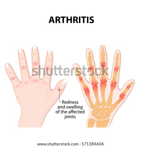 Osteoporosis Disease Characterized By Low Bone Stock Vector 184765475 ...