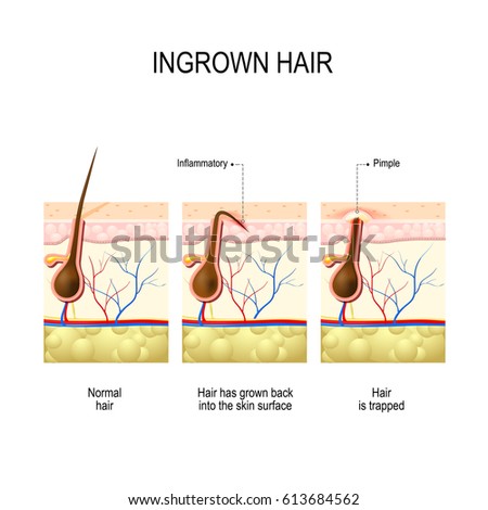 Diagram Hair Follicle Cross Section Skin Stock Illustration 166033388 ...