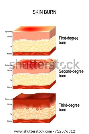 Scalding Stock Images, Royalty-Free Images & Vectors | Shutterstock