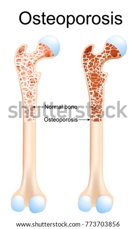 Femur Stock Images, Royalty-Free Images & Vectors | Shutterstock