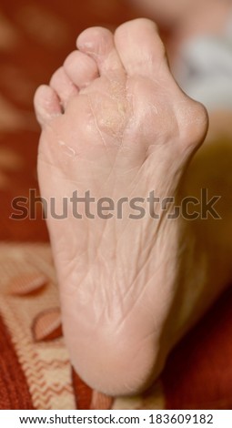 Hyperkeratosis Stock Photos, Royalty-Free Images & Vectors - Shutterstock