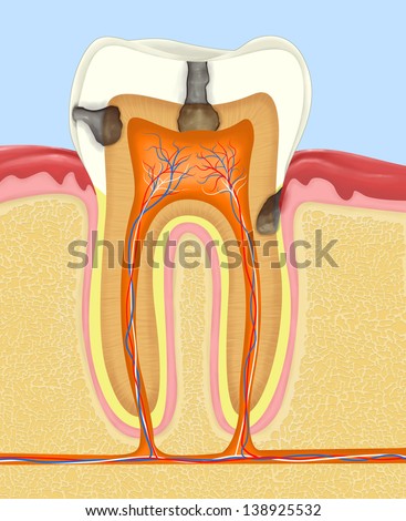 Tooth Cavity Stock Photos, Images, & Pictures | Shutterstock