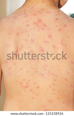 chicken pox on teen boys peregant women and girl teen