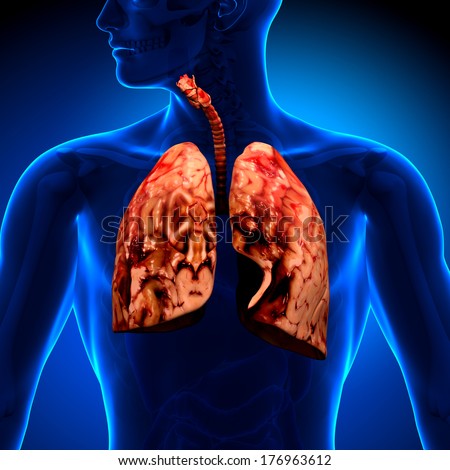 Types Of Lung Diseases  Their Causes