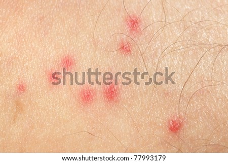 macro texture burns on human skin stock photo 415678729 macro texture burns on human skin stock photo 415678729 macro texture burns on human skin stock photo 415678729 macro texture burns on human skin stock photo 415678729