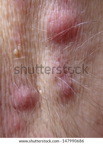 Acne Inversa Hidradenitis Suppurativa Armpit Stock Photo 147990656