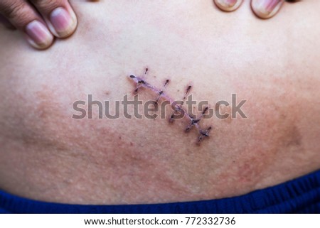 Appendicitis Scar Stock Images Royalty Free & Vectors.