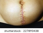 Small photo of Seams on woman's belly after childbirth. Big seam after the operation of Caesarian section
