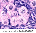 Small photo of Fetal ovary. Oocyte meiosis Micrograph showing an oocyte in diplotene stage (large central cell). In this stage, homologous chromosomes separate but remain tightly bound at chiasmata