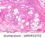 Small photo of Benign prostatic hyperplasia. Hyperplastic nodule composed of glandular elements with marked papillary infoldings and small corpora amylacea (prostatic concretions). The scale bar corresponds to 2 mm.
