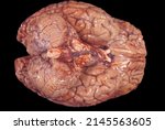 Small photo of Gross anatomy of the ventral surface of a human brain showing cerebellum, medulla oblongata, pons (with subarachnoid diffuse hemorrages), optic chiasm and nerves tract and olfactory tract and bulb