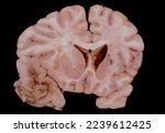 Small photo of Human brain. Coronal section (thalamus level) showing a large abscess, probably of bacterial origin, located in the temporal lobe. The abscess produces a deviation of the lateral ventricle.