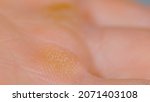 Small photo of MACRO, DOF: Hard callouses formed on the palm of an unrecognizable male climber. Detailed shot of a worker's hardened skin on the inside of their hands caused by heavy manual labor. Hardened skin.