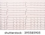 Small photo of Extrasystole On 12 Lead Electrocardiogram Record Paper
