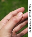 Small photo of left thumb finger joint get sudden, intense pain in a night without warning looks like gout or rheumatoid symptom, Inflammation, redness, swollen, tender, warm and limited motion movement
