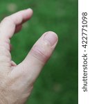 Small photo of left thumb finger joint get sudden, intense pain in a night without warning like gout or rheumatoid symptom, Inflammation, redness, swollen, tender, warm and limited motion movement, green background