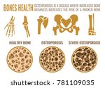 Osteoporosis Stages Image....