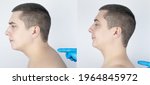 Small photo of Before and after kyphosis. The man suffers from a curvature of the spine in the upper section. The cervical vertebrae bulge out and form a hump. Curvature and incorrect posture treatment concept