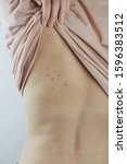 Small photo of Damaged skin on female's back. Bedbug bites, moosquito bites or skin disease on human body, vertical shot