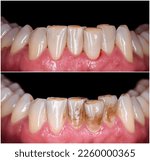 Small photo of teeth tartar and calculus deep cleaning