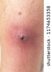 Small photo of A carbuncle at leg surrounding with cellulitis.