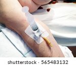 Intravenous Catheter. Operation....