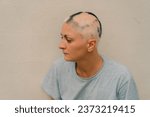 Small photo of Real alopecia areata in a young girl. A bald head in a person. Diffuse alopecia. Androgenic alopecia. Hair loss. Bald spots on the head. Trichology. High quality photo