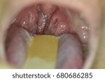 Small photo of Zooming closeup view of enlarged inflamed tonsil glands in a young Asian woman comes with history of long duration sore throat and snoring with difficulty in swallowing