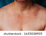Age spots, moles and freckles on the neck and chest of an older woman. Spots on the body. Decollete area neckline of an elderly woman