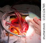 Small photo of Mechanical valve (artificial valve) for Mitral valve replacement in open heart surgery with cardiopulmonary bypass