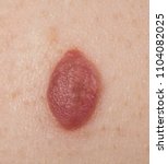 Small photo of Inborn mole close up. Macro shot of benign skin lesion. Proliferation of pigment derma cells, melanocytic pigmented naevus, naevocytic nevus.