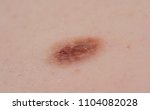 Small photo of Inborn mole close up. Macro shot of benign skin lesion. Proliferation of pigment derma cells, melanocytic pigmented naevus, naevocytic nevus.