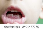 Small photo of Close up, boy opens his mouth and shows his milky teeth. One missing tooth replaced with permanent toot. . High quality photo