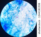 Small photo of Cryptosporidium oocyst in Stool ,mAFB. The Cryptosporidium reveals red round oocyst 4-6 um in diameter , oocyst with 4 sporozoites , sporozoite as crescent shape