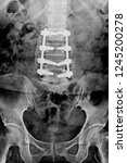 Small photo of Scanned images of the spine (Bone Fracture) and through metal surgery . Surgical steel dam , flim x-ray