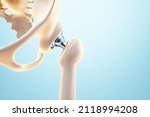 Medical Poster Image Of A Hip...