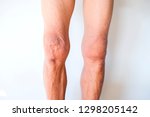 Health Care  Medical,Old man's legs on a white background