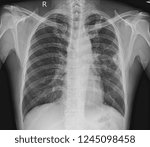 Small photo of Chest x-ray showing A 3 cm pleural based nodule at Lt upper lobe with splicated margin. Thickening of nearby pleural. Nodular infiltration at RUL. differential diagnosis CA lung.