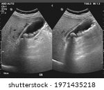 ultrasonography image of gallbladder with gall stones at upper abdomen