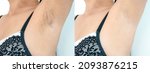 Small photo of Close up underarm chicken skin problem in Asian woman armpit, Fox Fordyce, black armpit in woman. Before and after skincare cosmetology armpits epilation treatment concept.