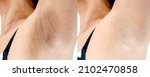 Small photo of Close up Women armpit with problem black armpit. Dark and wrinkle armpit from deodorant allergic