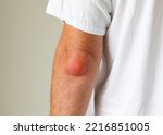 Small photo of Man swelling erythematous lump pain elbow from Olecranon bursitis, student elbow medical condition. Inflammation of the bursa located under the elbow Olecranon trauma or repetitive smaller traumas.