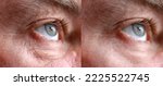 Small photo of Closeup 45-50 years old shows the before and after results of successful blepharoplasty surgery, corrective procedure to remove puffy and swollen bags beneath the eye.